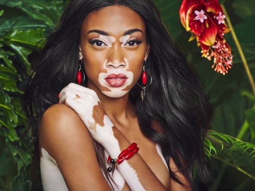 Día Mundial del Vitiligo: El papel del mundo de la moda para eliminar el estigma